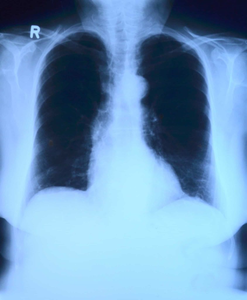 x-ray image, roentgen, thorax